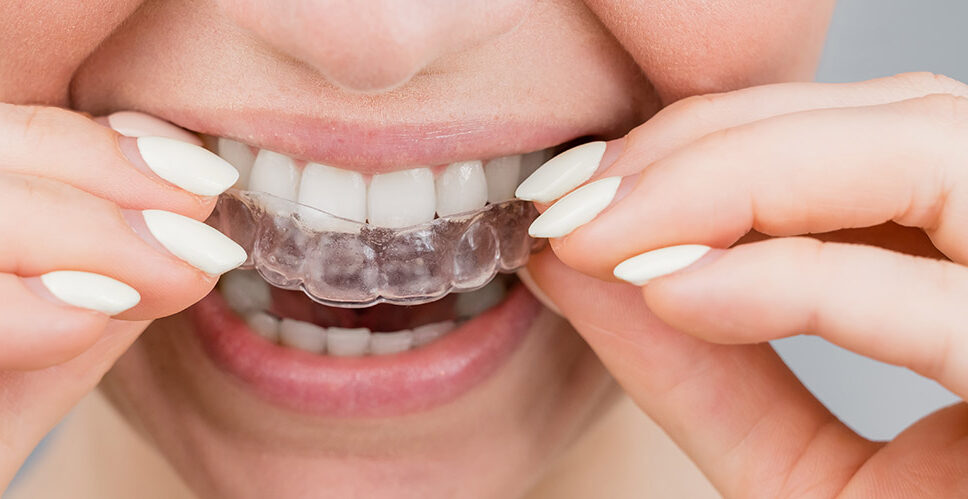 Invisalign, quelle est cette méthode à fort succès !